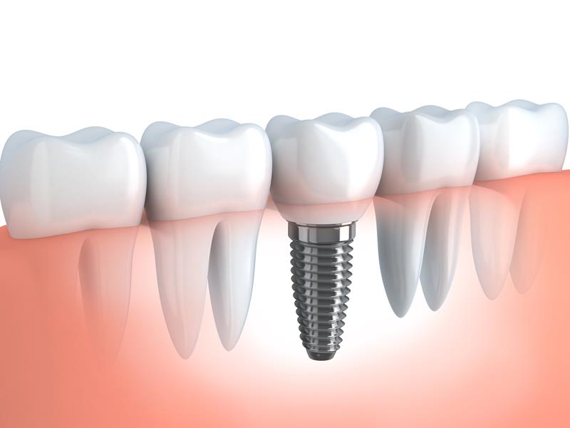Dental Implants Tacoma, WA 